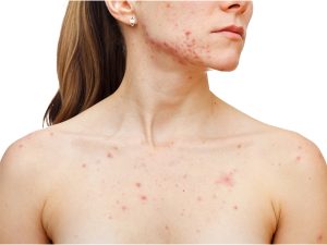 chest acne, paloa lto, acne treatment