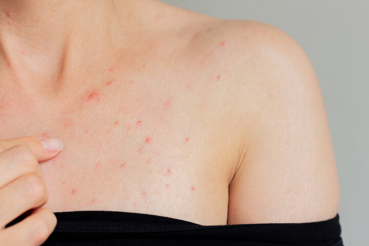 chest acne, acne facial, palo alto