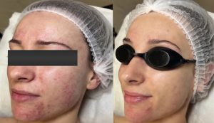 before and after acne