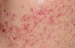acne PIH , dark spots acne, palo alto