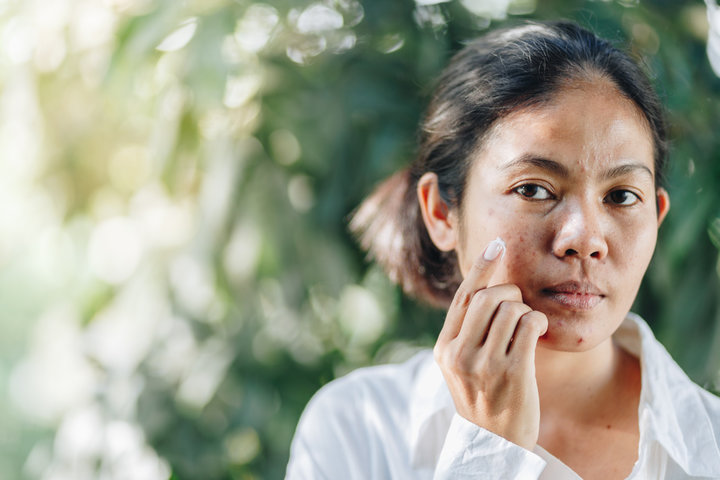adult acne, palo alto, acne facial