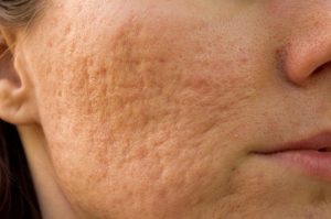 acne scars, acne, palo alto