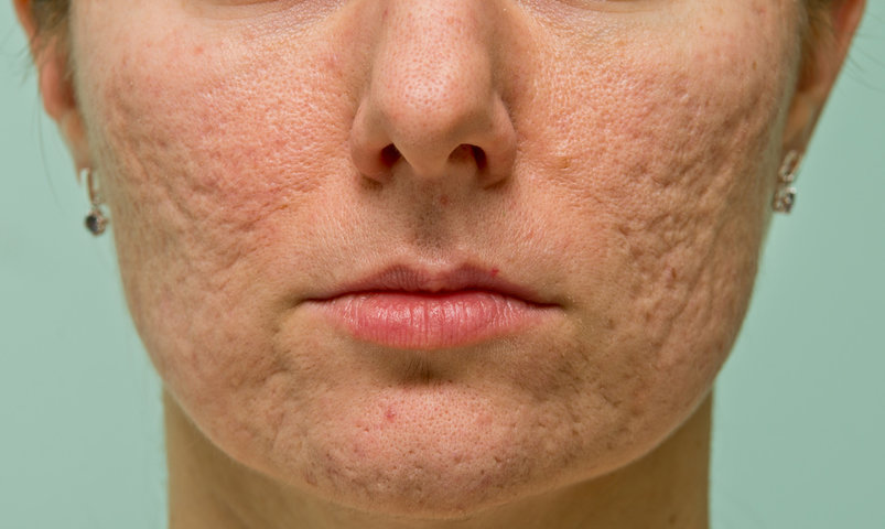 acne scars, acne facial, palo alto